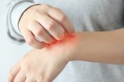 Une personne se gratte la main à cause d'une allergie.