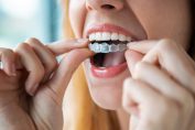 Une femme met son aligneur dentaire
