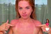 Une jeune femme montre ses coups de soleil.