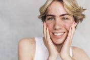 Un garçon avec des boutons d'acné