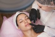 Injection d'acide hyaluronique dans les lèvres d'une femme